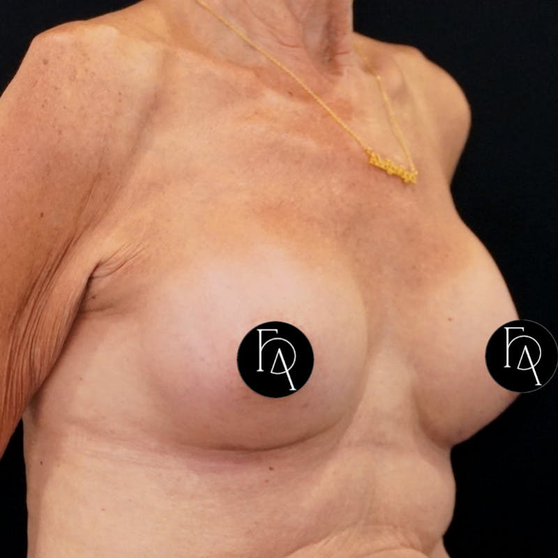 Breast Augmentation Before & After Gallery - Patient 162727 - Image 4