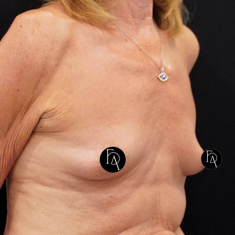 Breast Augmentation Before & After Gallery - Patient 162727 - Image 3