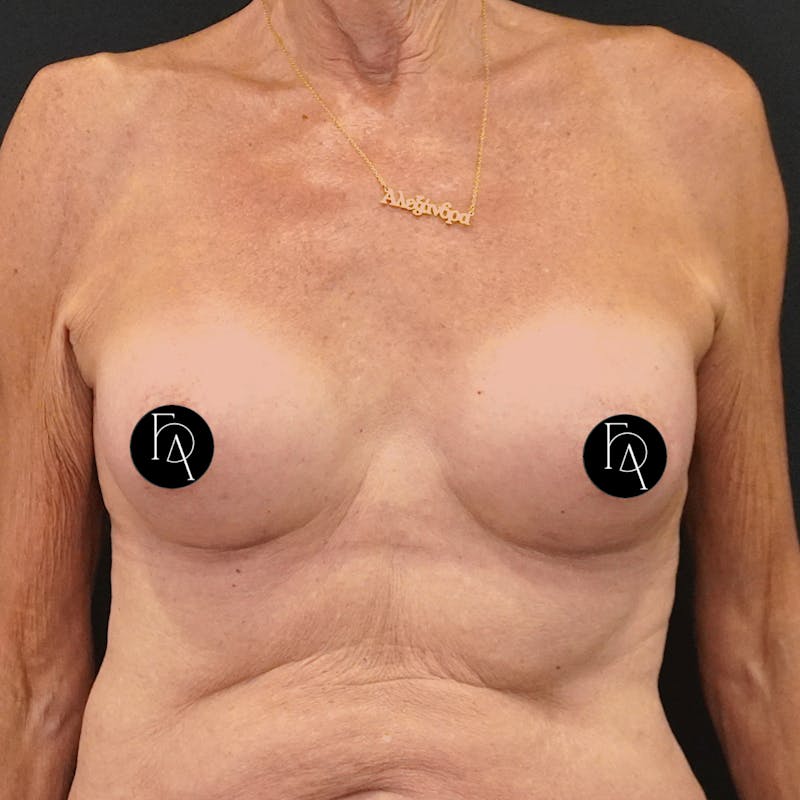Breast Augmentation Before & After Gallery - Patient 162727 - Image 2