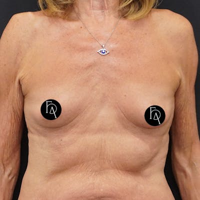 Breast Augmentation Before & After Gallery - Patient 162727 - Image 1