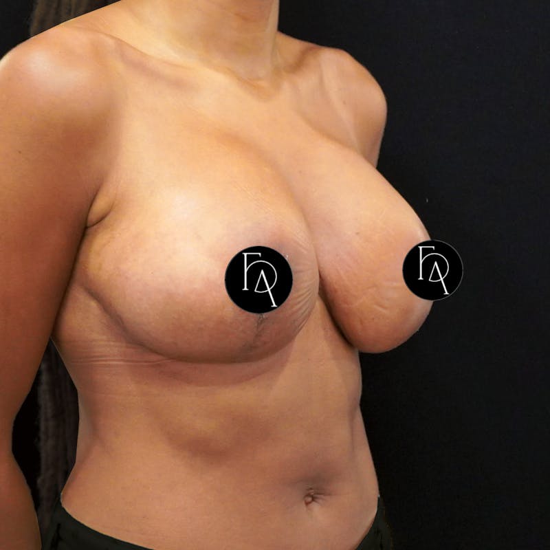 Breast Lift (Mastopexy) Before & After Gallery - Patient 284435 - Image 4