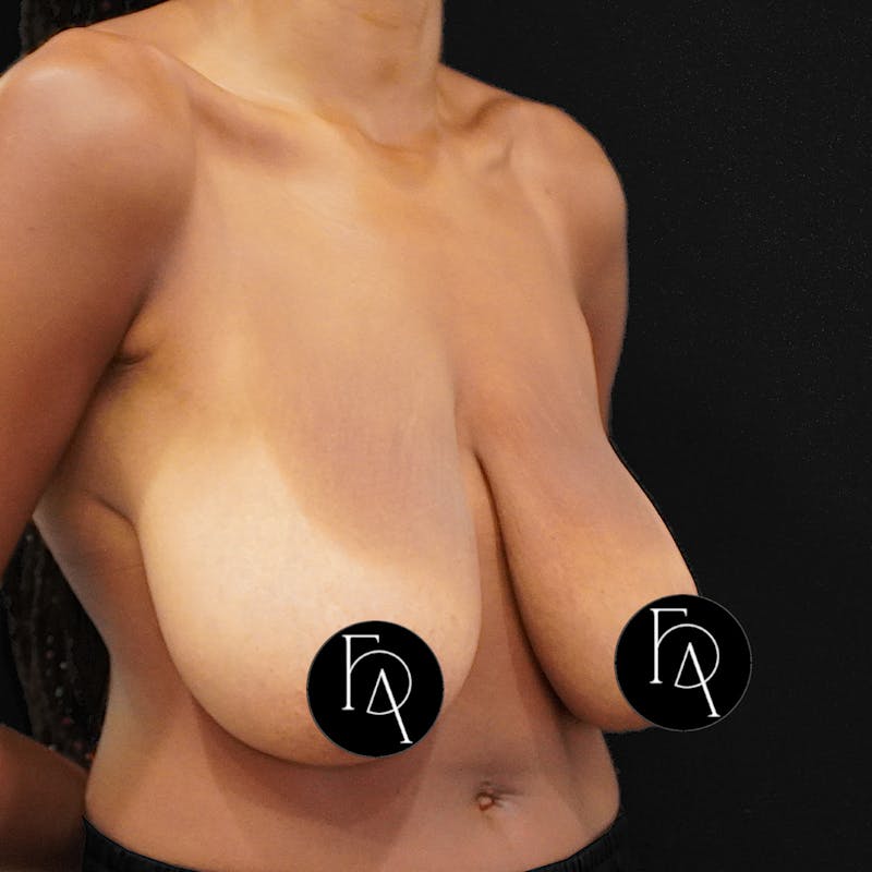 Breast Lift (Mastopexy) Before & After Gallery - Patient 284435 - Image 3