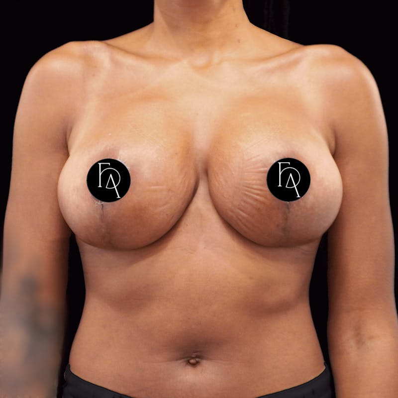 Breast Lift (Mastopexy) Before & After Gallery - Patient 284435 - Image 2