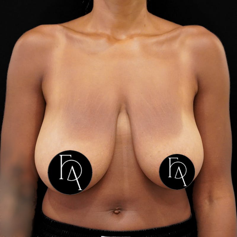 Breast Lift (Mastopexy) Before & After Gallery - Patient 284435 - Image 1