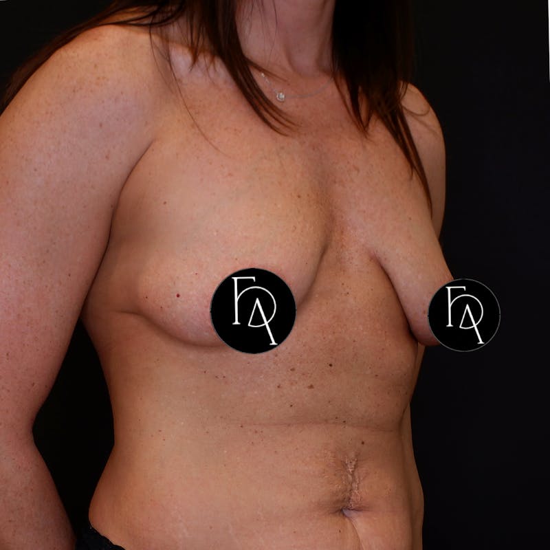 Breast Lift (Mastopexy) Before & After Gallery - Patient 668612 - Image 3