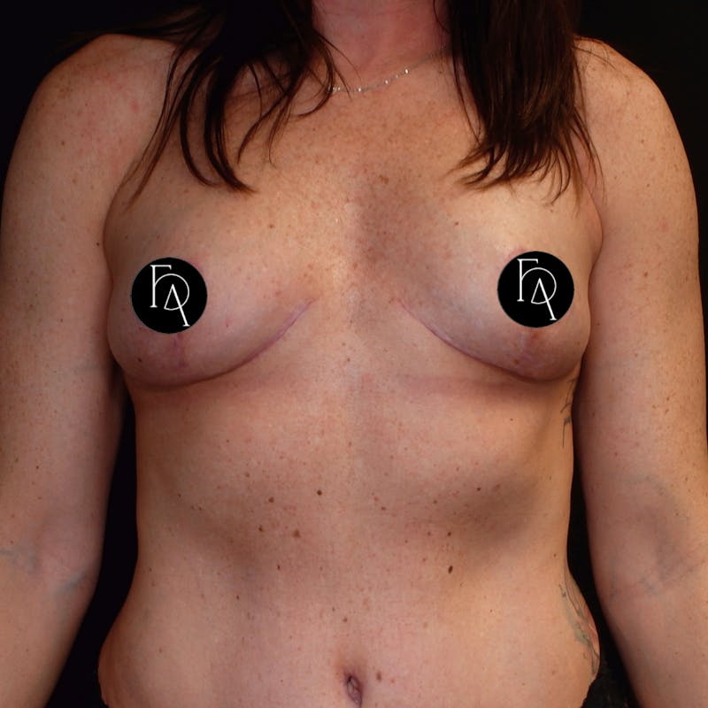 Breast Lift (Mastopexy) Before & After Gallery - Patient 668612 - Image 2