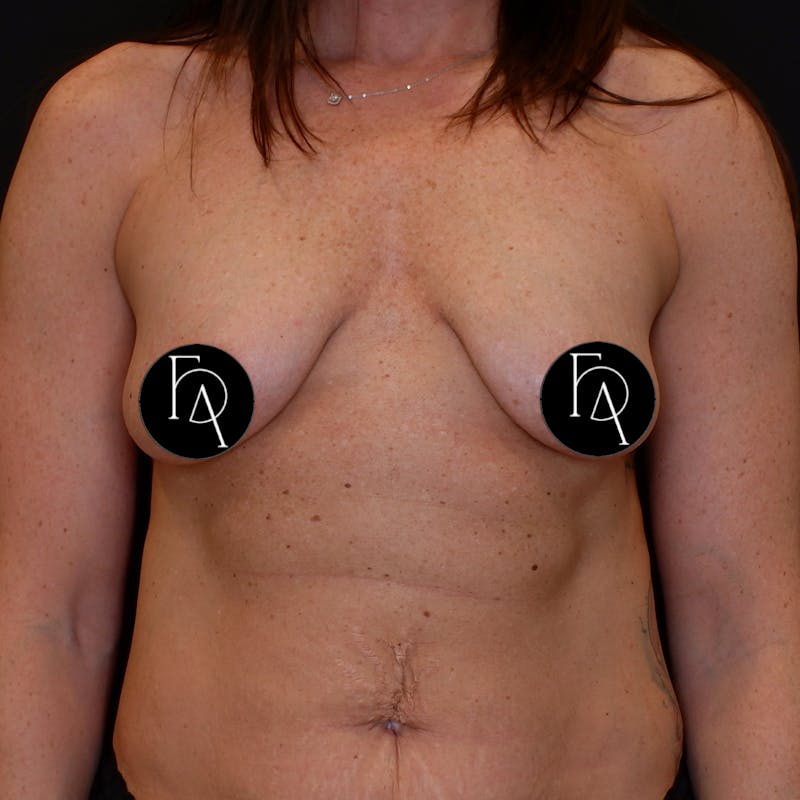 Breast Lift (Mastopexy) Before & After Gallery - Patient 668612 - Image 1
