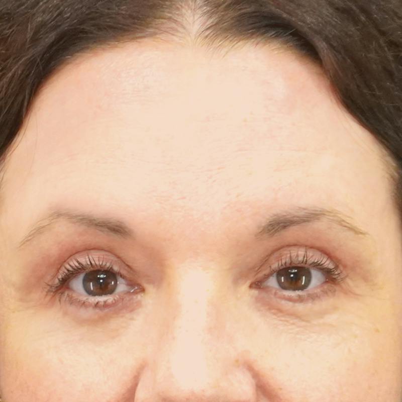 Brow Lift Before & After Gallery - Patient 385219 - Image 2