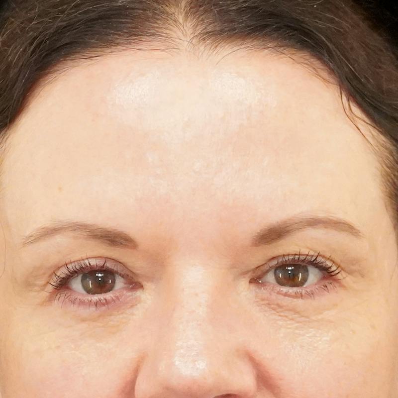 Brow Lift Before & After Gallery - Patient 385219 - Image 1