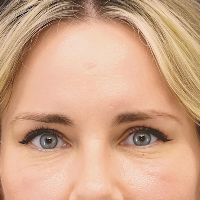 Brow Lift Before & After Gallery - Patient 406992 - Image 2