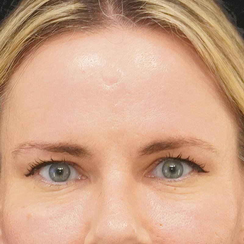 Brow Lift Before & After Gallery - Patient 406992 - Image 1