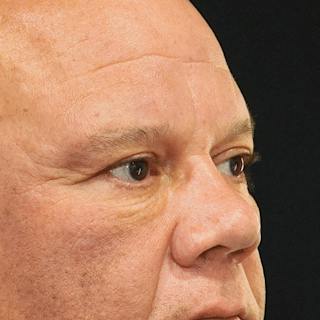 Lower Blepharoplasty Before & After Gallery - Patient 196614 - Image 4