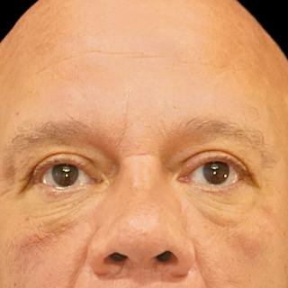 Lower Blepharoplasty Before & After Gallery - Patient 196614 - Image 2
