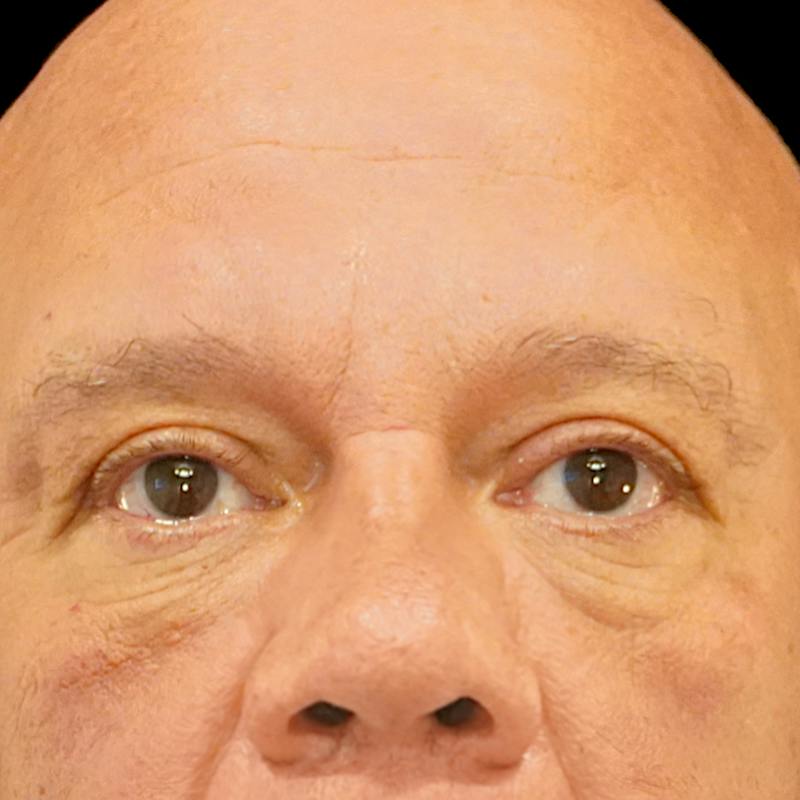 Lower Blepharoplasty Before & After Gallery - Patient 196614 - Image 2