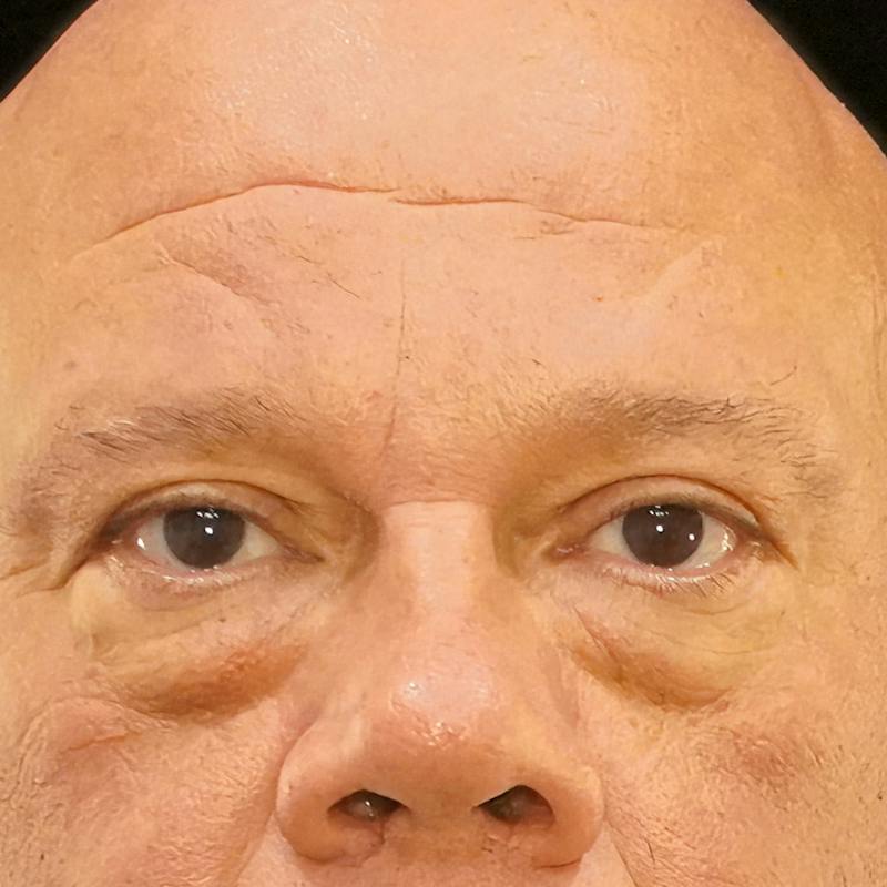 Lower Blepharoplasty Before & After Gallery - Patient 196614 - Image 1