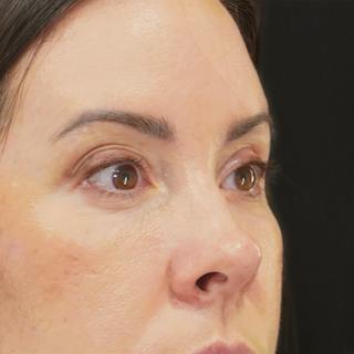 Lower Blepharoplasty Before & After Gallery - Patient 137756 - Image 4