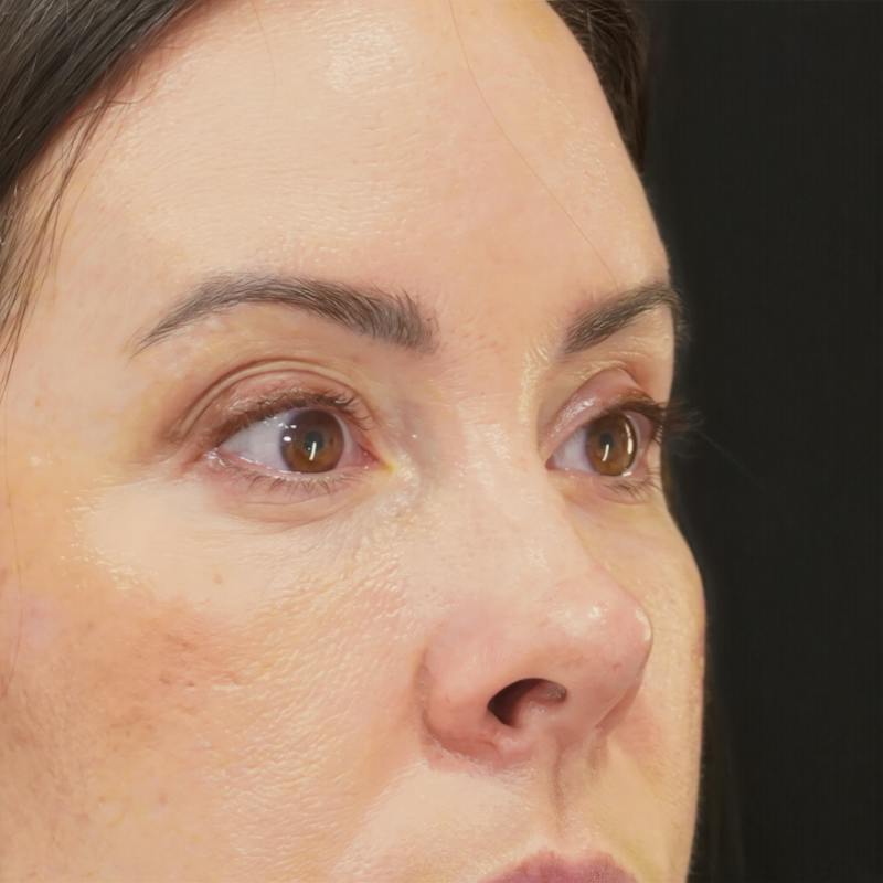 Lower Blepharoplasty Before & After Gallery - Patient 137756 - Image 4