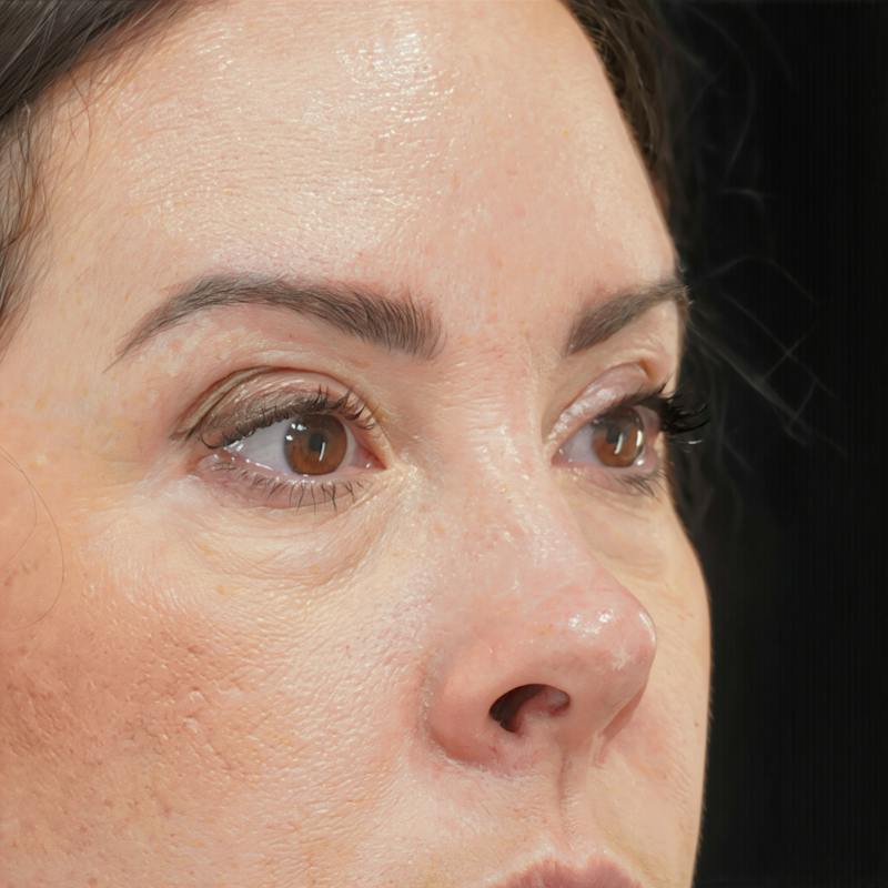 Lower Blepharoplasty Before & After Gallery - Patient 137756 - Image 3
