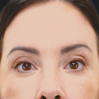 Lower Blepharoplasty Before & After Gallery - Patient 137756 - Image 2