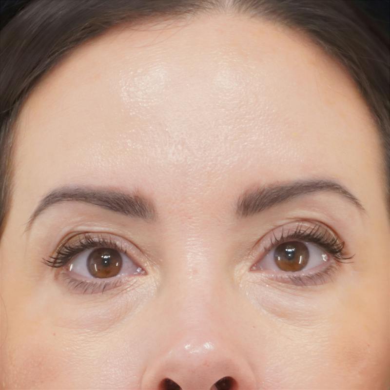 Lower Blepharoplasty Before & After Gallery - Patient 137756 - Image 1