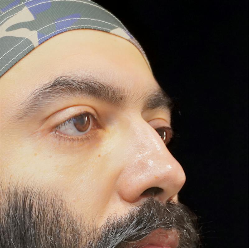 Lower Blepharoplasty Before & After Gallery - Patient 830678 - Image 4