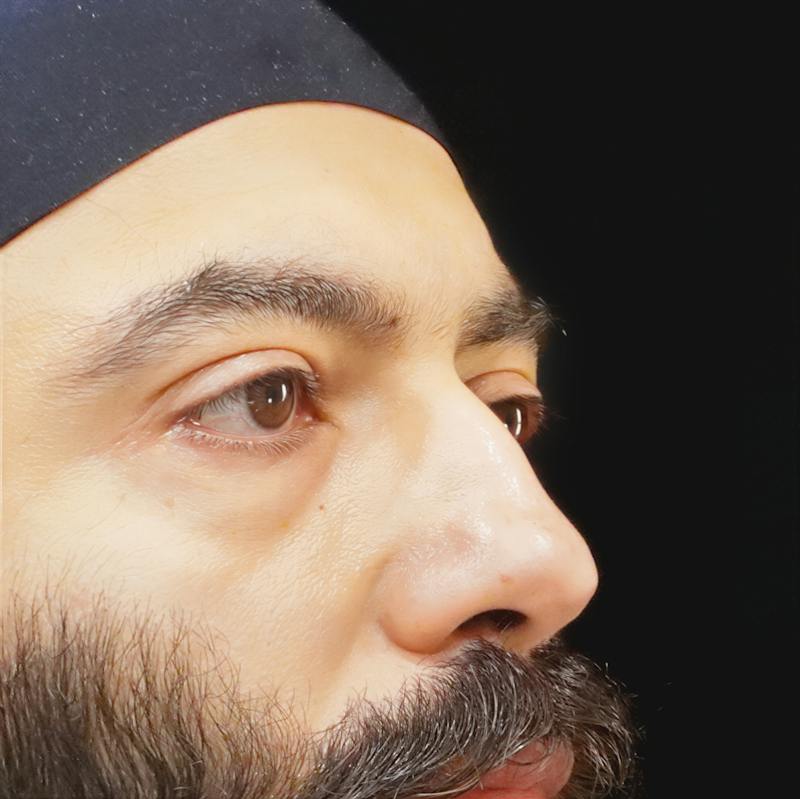 Lower Blepharoplasty Before & After Gallery - Patient 830678 - Image 3