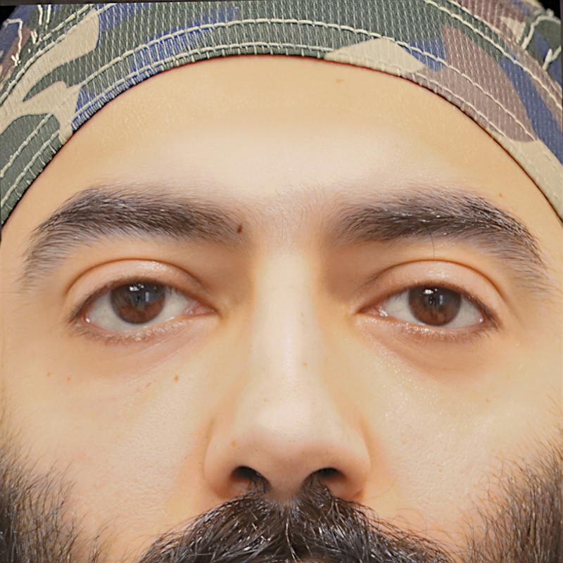 Lower Blepharoplasty Before & After Gallery - Patient 830678 - Image 2