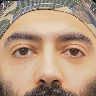 Lower Blepharoplasty Before & After Gallery - Patient 830678 - Image 2