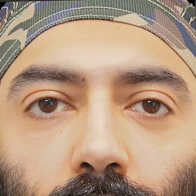 Lower Blepharoplasty Before & After Gallery - Patient 830678 - Image 2
