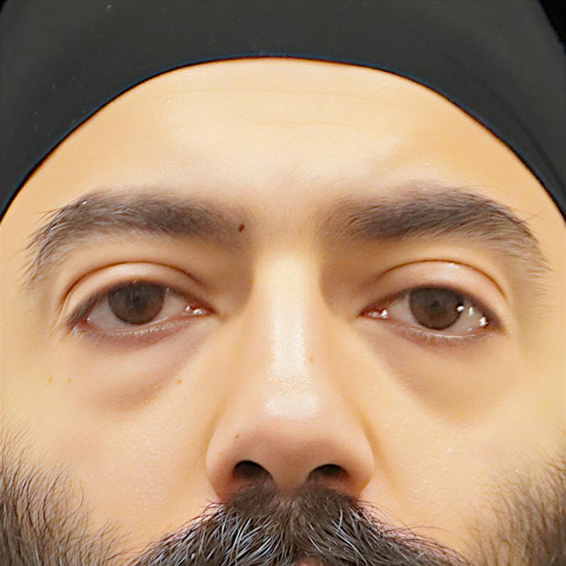 Lower Blepharoplasty Before & After Gallery - Patient 830678 - Image 1