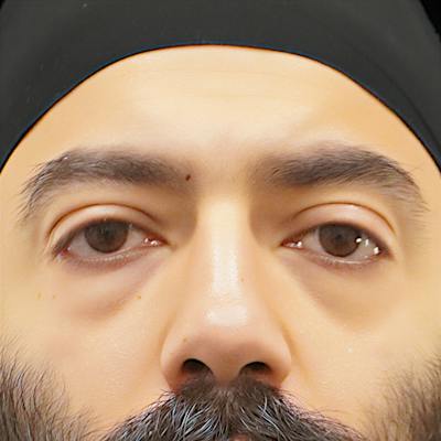 Lower Blepharoplasty Before & After Gallery - Patient 830678 - Image 1
