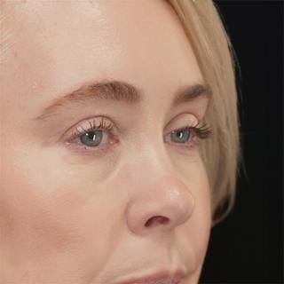 Upper Blepharoplasty Before & After Gallery - Patient 159062 - Image 4