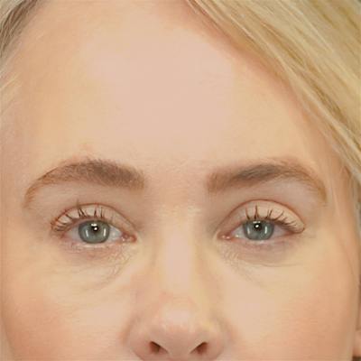 Upper Blepharoplasty Before & After Gallery - Patient 159062 - Image 2