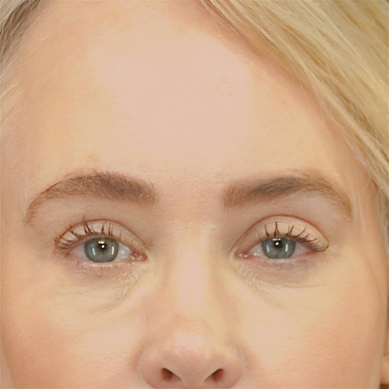 Upper Blepharoplasty Before & After Gallery - Patient 159062 - Image 2