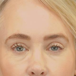 Upper Blepharoplasty Before & After Gallery - Patient 159062 - Image 2