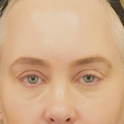 Upper Blepharoplasty Before & After Gallery - Patient 159062 - Image 1