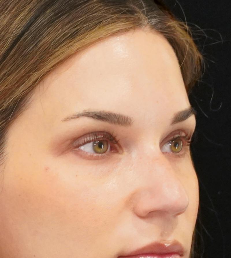 Upper Blepharoplasty Before & After Gallery - Patient 250146 - Image 4