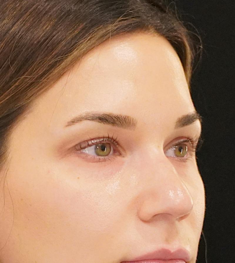 Upper Blepharoplasty Before & After Gallery - Patient 250146 - Image 3