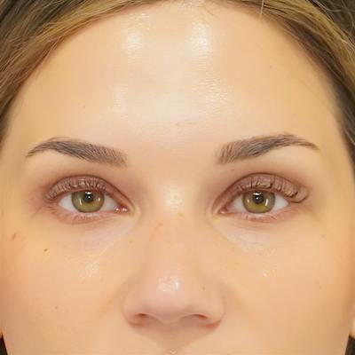 Upper Blepharoplasty Before & After Gallery - Patient 250146 - Image 2