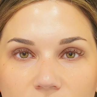Upper Blepharoplasty Before & After Gallery - Patient 250146 - Image 2