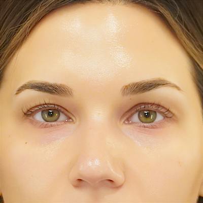 Upper Blepharoplasty Before & After Gallery - Patient 250146 - Image 1