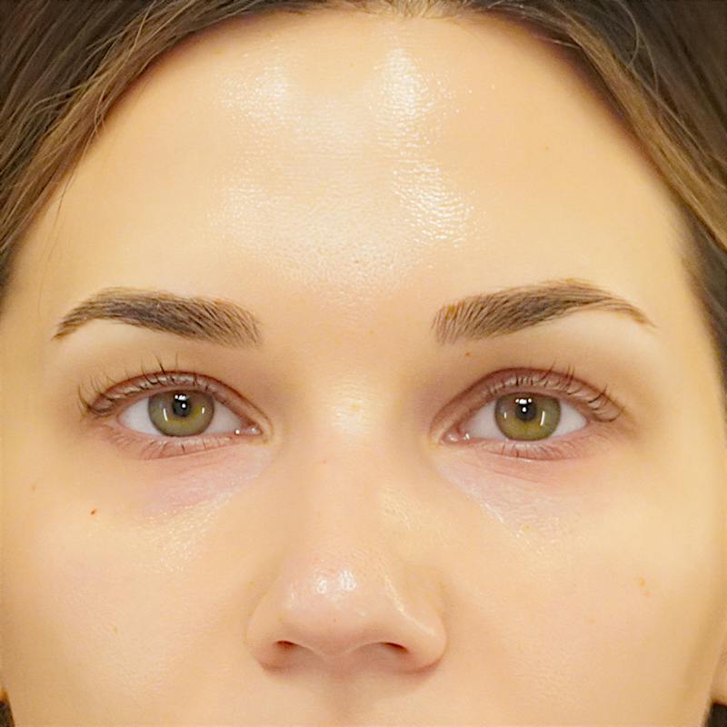 Upper Blepharoplasty Before & After Gallery - Patient 250146 - Image 1