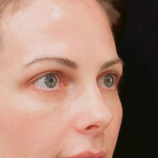 Upper Blepharoplasty Before & After Gallery - Patient 186267 - Image 4