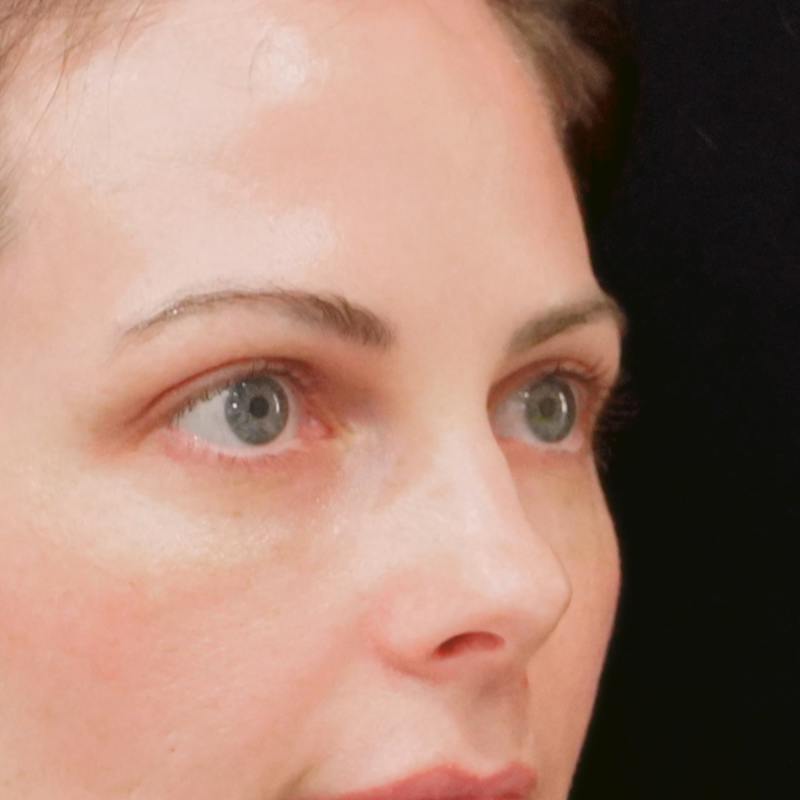 Upper Blepharoplasty Before & After Gallery - Patient 186267 - Image 4
