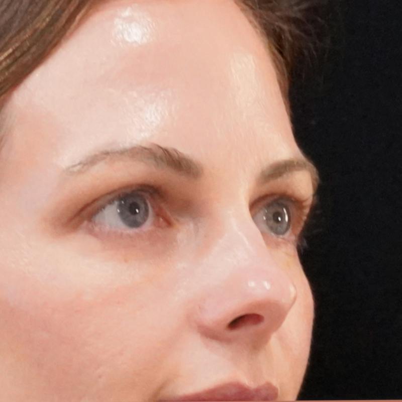 Upper Blepharoplasty Before & After Gallery - Patient 186267 - Image 3