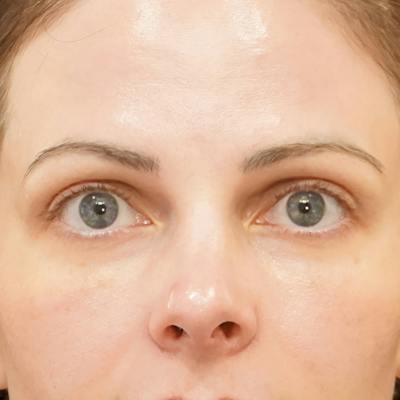 Upper Blepharoplasty Before & After Gallery - Patient 186267 - Image 2