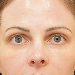 Upper Blepharoplasty Before & After Gallery - Patient 186267 - Image 2