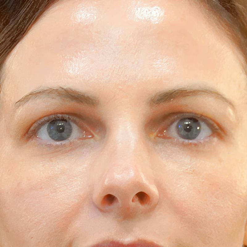 Upper Blepharoplasty Before & After Gallery - Patient 186267 - Image 1