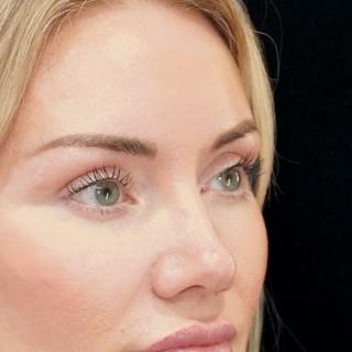 Upper Blepharoplasty Before & After Gallery - Patient 253391 - Image 4