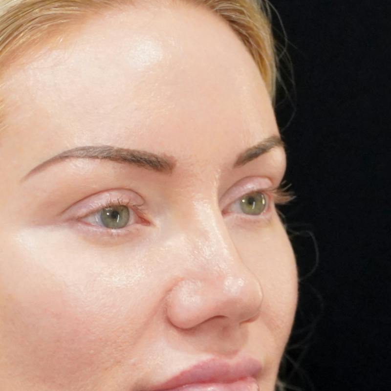 Upper Blepharoplasty Before & After Gallery - Patient 253391 - Image 3